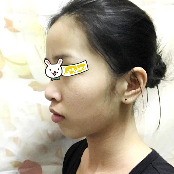 广州时光整形医院激光祛痘坑案例 瞬间恢复光滑皮肤做真正的女人