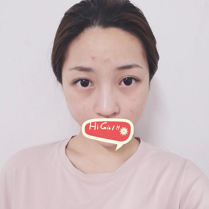 深圳太美医院隆鼻案例 丑鼻消失之迷 直播网红美女的诞生
