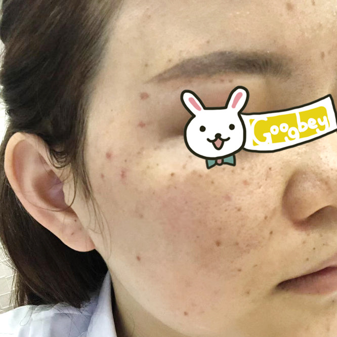 在广州名韩整形医院做了光子嫩肤后 让我彻底告别了“麻子脸” 拥有光洁肌肤
