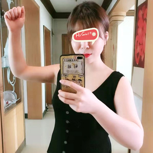 杭州时光整形医院做手臂吸脂过程分享 让我终于摆脱了“女汉子”形象