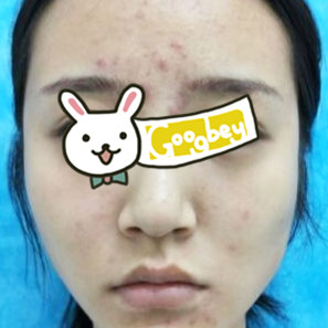 杭州博雅整形医院激光祛痘 让我彻底摆脱了讨厌的痘痘 拥有光洁美肌