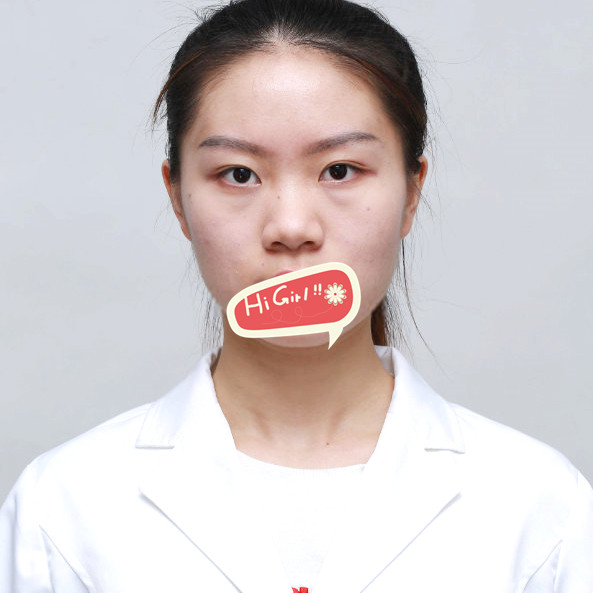 北京美联臣整形医院做假体隆鼻后 不止是鼻子变美了 整个人都更有气质了