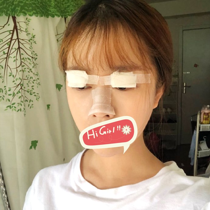 上海喜美医院隆鼻双眼皮案例 直播塌鼻眼小三个月逆袭网红少女