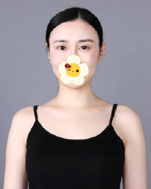 北京京美会整形医院隆胸案例 旺仔小馒头变西瓜胸的华丽蜕变