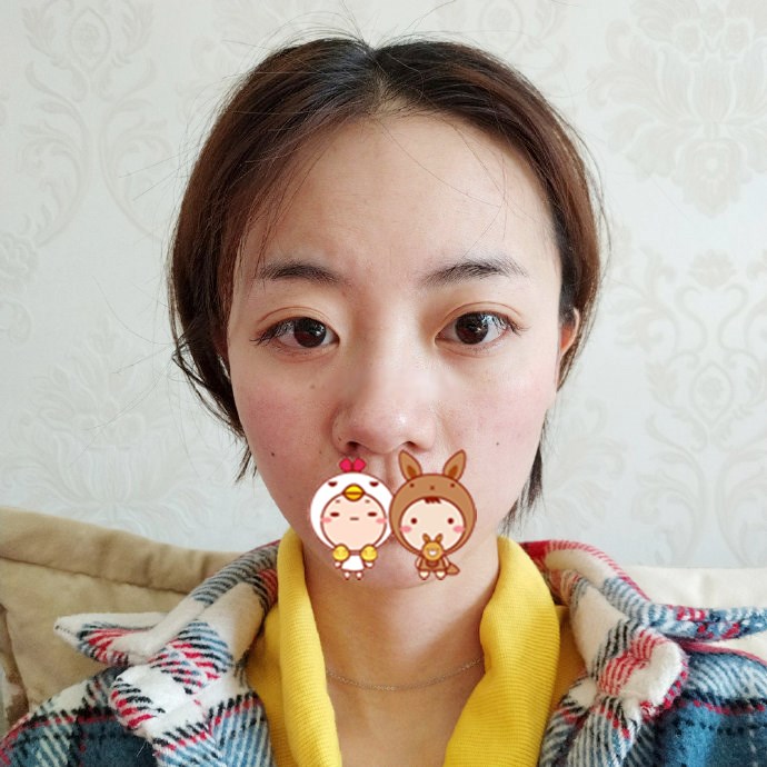 上海华美整形医院隆鼻案例 揭秘塌鼻女孩的艰难隆鼻历程
