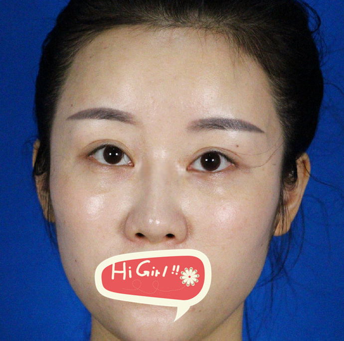 在北京柏丽医整形医院做鼻综合附图 来一起见证精致美鼻的诞生