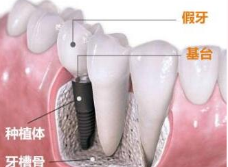 种植牙能用几年 北京芽美口腔医院牙齿种植多少钱一颗