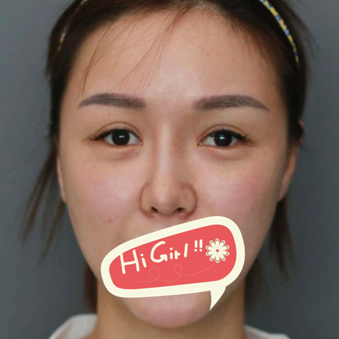 上海俪人整形医院做隆鼻修复案例 终于摆脱了隆鼻失败的困扰