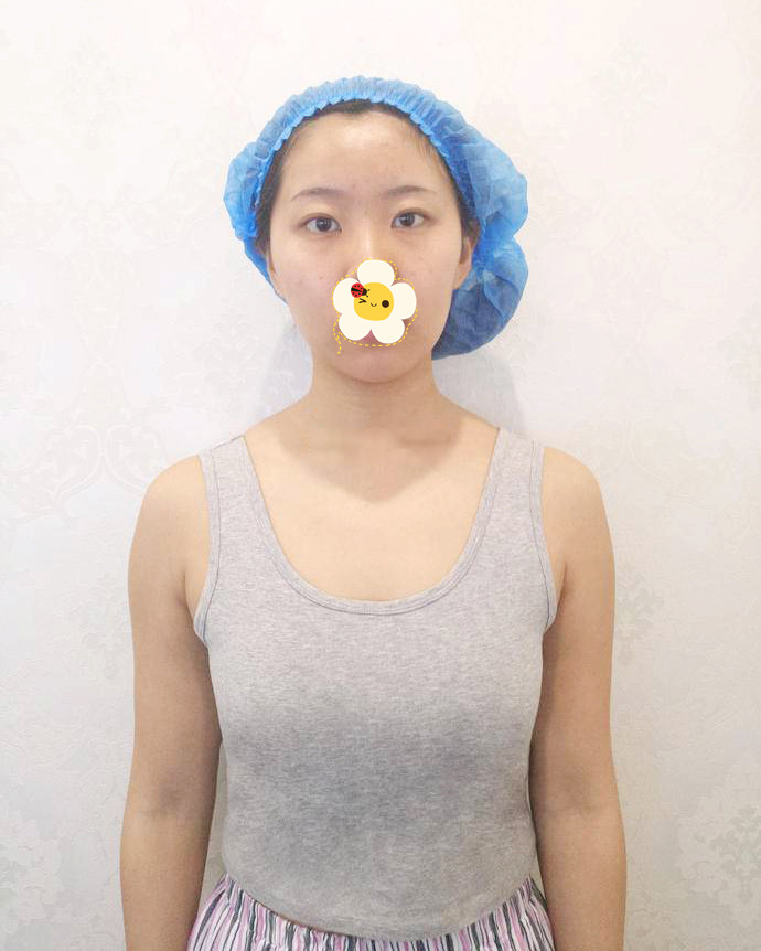 杭州佰丽整形医院做假体隆胸真实案例 让我告别平胸的烦恼