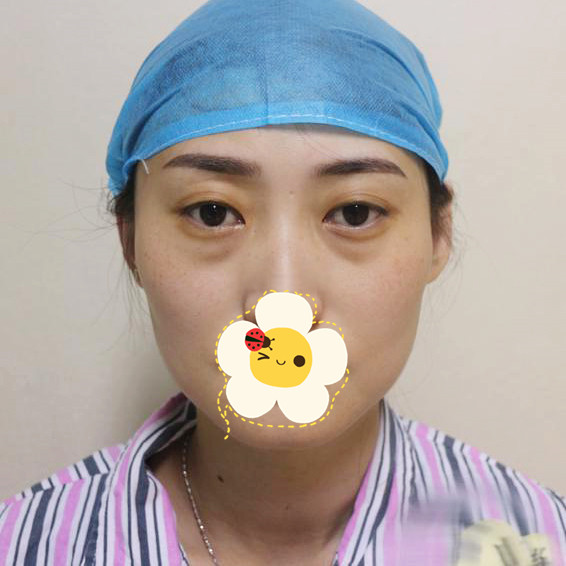 武汉慧丽源整形医院做内切去眼袋手术 让我的眼睛变的年轻有活力