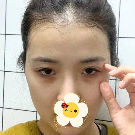 在深圳伊婉整形医院去眼袋真实经历分享 一个月成为女神的全记录(附图）
