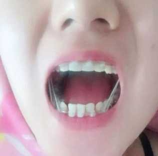 杭州美莱口腔医院牙齿矫正后效果图 恢复的整整齐齐 太棒了
