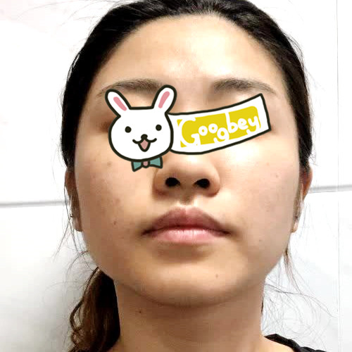 我在深圳米兰柏羽整形医院做光子嫩肤 从此告别化妆 做素颜女神