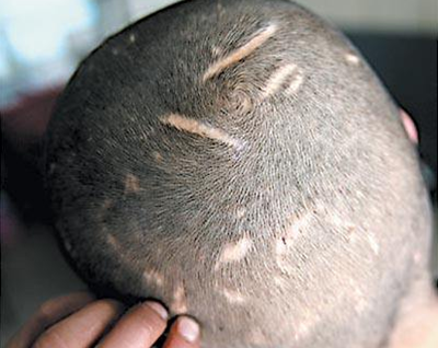 四川大学华西保健医院毛发移植科做疤痕植发多少钱