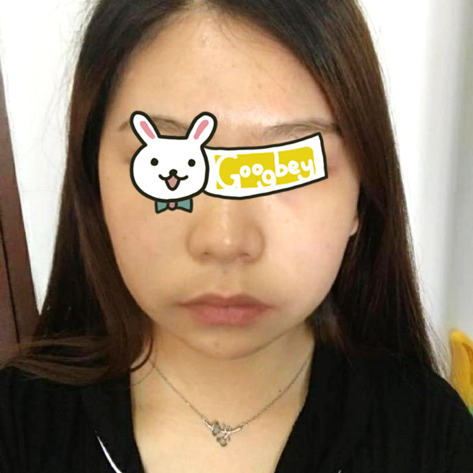 北京京都时尚整形医院下颌角磨骨案例 告别了我难看的大脸盘子