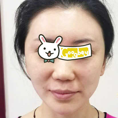 在杭州薇琳整形医院做的激光去红血丝效果 终于摆脱了“高原脸”
