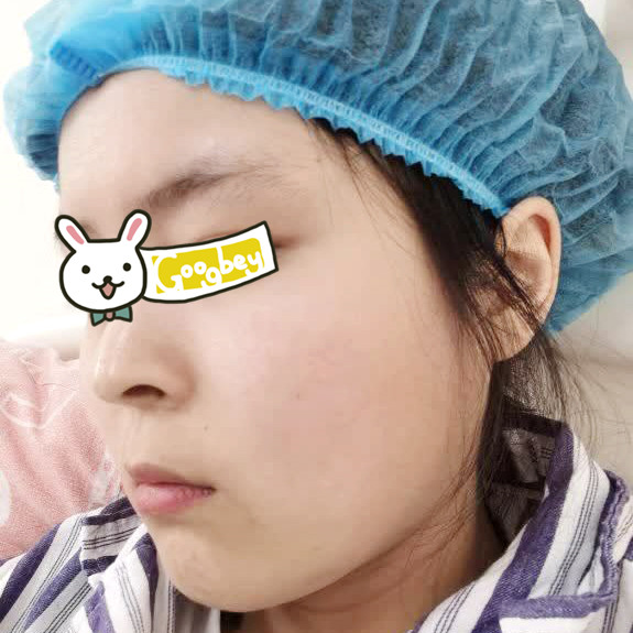 在北京华韩整形医院做硅胶假体垫下巴效果 脸型自然无整形痕迹