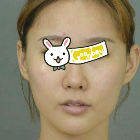 北京丽雅整形医院做了光子嫩肤后 皮肤变得紧致通透 光滑白嫩