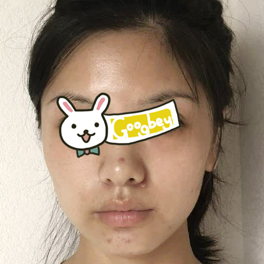在重庆艺星整形医院做光子嫩肤半年后效果 一次解决皮肤暗黄 痘痘 粗糙