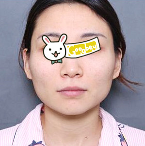 上海首尔丽格整形医院下颌角磨骨案例 我的变脸全过程 给大家分享