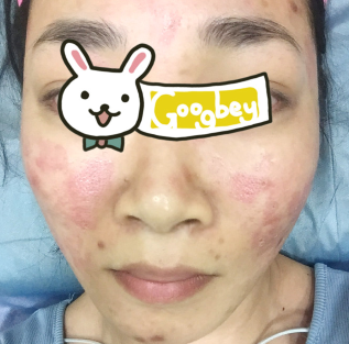 在重庆新桥医院整形科做激光祛痘后皮肤变好了 彻底告别痘痘肌