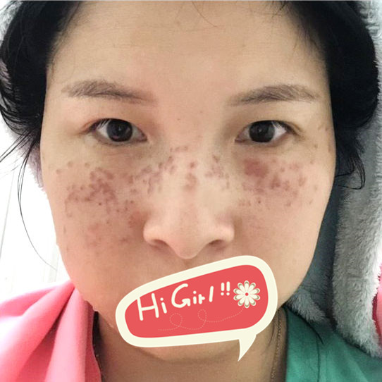 我在郑州153医院激光科做了皮秒祛斑 终于摆脱了多年的斑斑脸