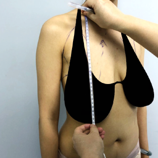 青海欣怡整形医院乳房下垂矫正后重回高挺双峰 胸型比之前还性感