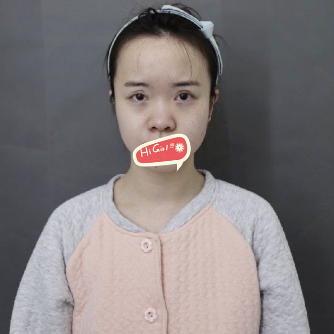 上海薇琳美容医院假体隆鼻鼻翼缩小案例 侧颜美得简直无敌了