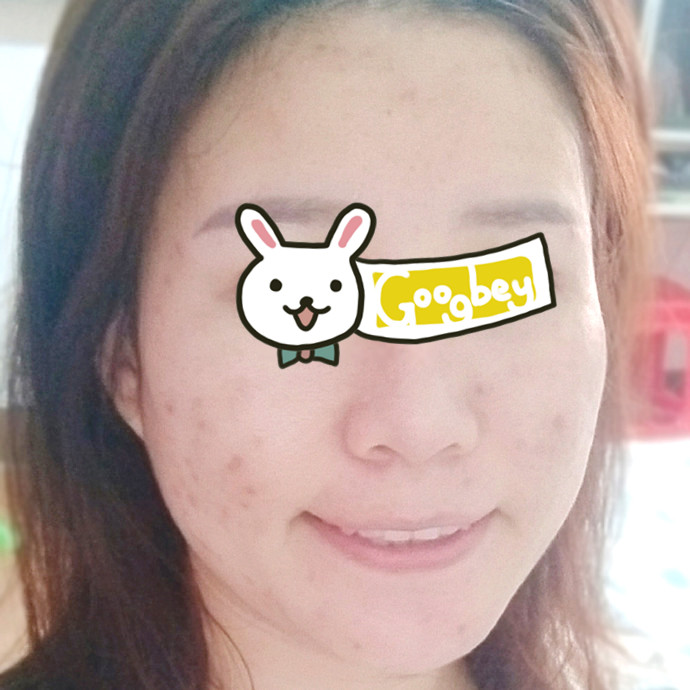 在北京海医悦美整形医院做了光子嫩肤 脸上细嫩光滑了不少