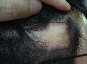 杭州碧莲盛植发专业吗 做疤痕植发需要多少钱