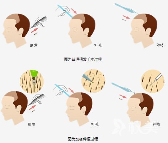 植发手术过程大揭秘 重庆雍禾植发效果怎么样