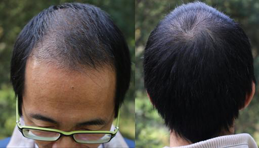 武汉三甲植发医院哪家好 头发加密需要多少钱