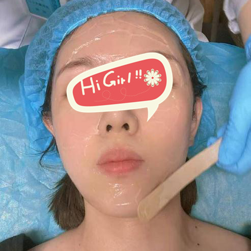 北京圣心整形医院光子嫩肤效果图 一次见效 皮肤水润润的