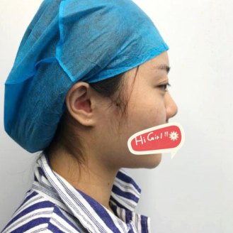 北京曙光医院整形科耳软骨隆鼻实拍案例 土妞变网红 很有立体感