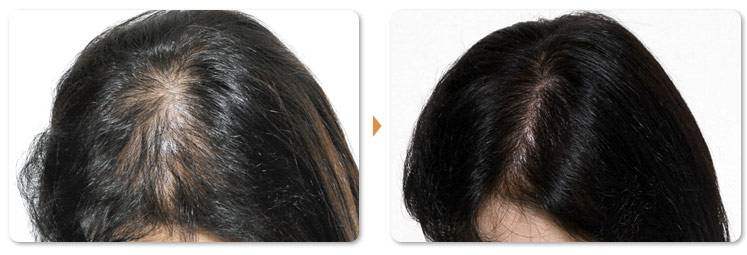天津科发源头发加密价格表 种植后多久能洗头