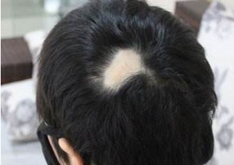 疤痕性脱发的原因有哪些 重庆东方疤痕植发效果及价格