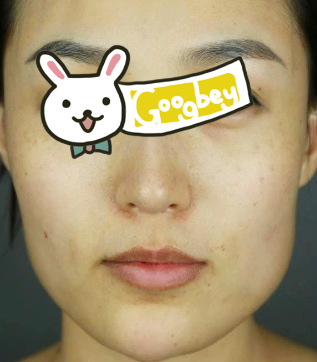 北京东方瑞丽医疗美容门诊部下颌角整形案例分享  小仙女变形记
