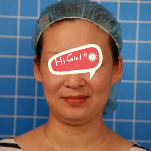 重庆当代整形医院双下巴吸脂案例分享 附恢复过程图片