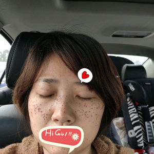 北京美莱美容整形医院激光祛斑案例 脸上干干净净真开心