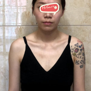 上海薇琳美容医院假体丰胸真实案例亲身体验分享