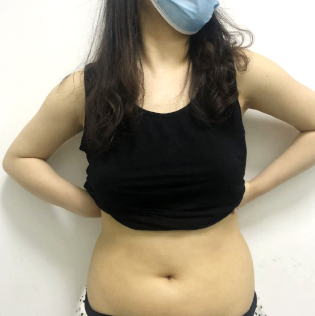 重庆骑士医院整形科腰腹吸脂真人案例 变化好大 轻松拥有蚂蚁腰