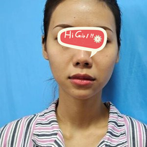 在北京凯润婷整形医院做热玛吉除皱后法令纹不见了 有效抗衰老