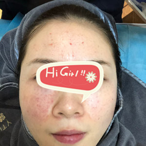 北京炫美整形医院光子嫩肤祛红血丝改善肤质 由内而外美白
