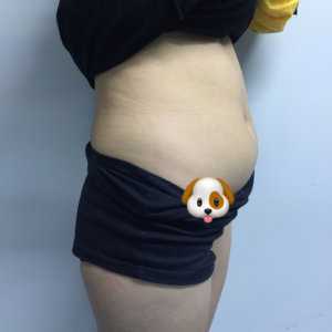 广州爱来整形医院腰腹吸脂案例 赋予了我期待许久的小蛮腰