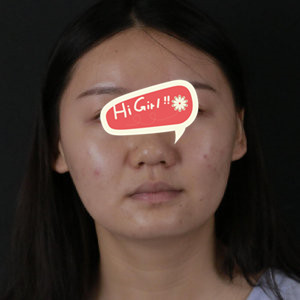 在上海美联臣整形医院做了激光溶脂瘦脸 塑造了我的气质小V脸