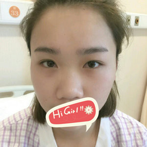 上海美之源整形医院鼻子综合真实案例 手术前后效果对比图