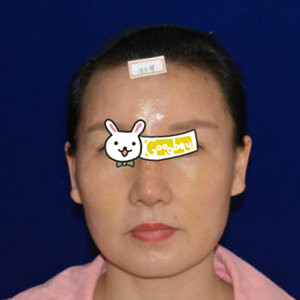 在上海比华利美容医院做超声刀紧致案例 年轻了10岁 美到极限