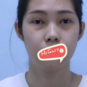 在深圳美度美容医院做激光去眼袋全过程 眼袋消失 我青春回来了