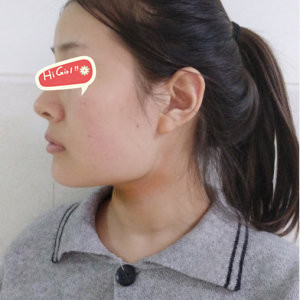 在北京斯嘉丽整形医院做了下颌角磨骨 U脸变V脸 我也是女神！