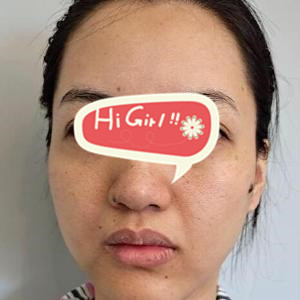 在天津维美美容医院做热玛吉面部提升案例 嫩白的肌肤改变了我的命运